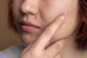 Cara Mengatasi Jerawat Hormonal Secara Alami